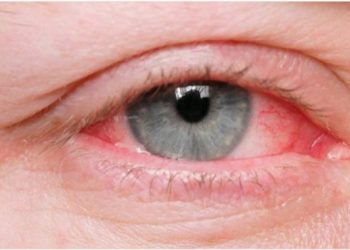 सुनसरी लगायत दुहबीमा पनि फैलियो आँखा पाक्ने रोग, कसरी जोगिने ?